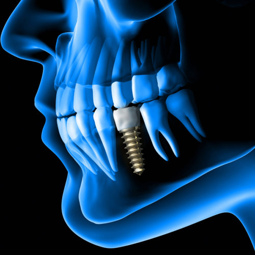 Implantología y Rehabilitación Oral sobre Implantes